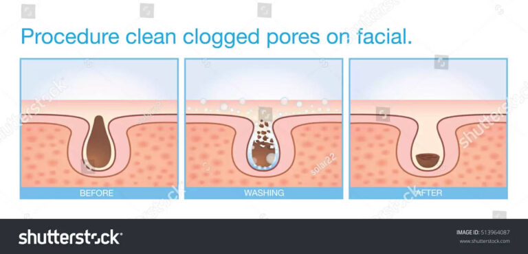 Top 10 Home Remedies To Get Rid Of Clogged Pores