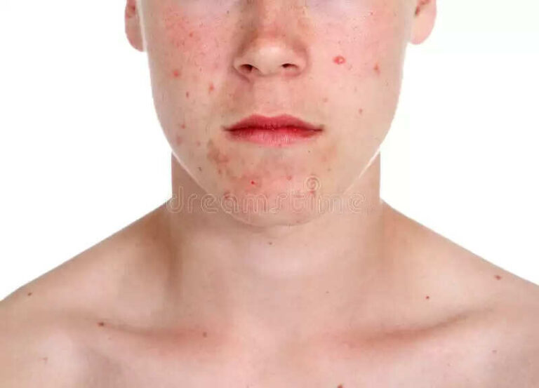 Top 5 DIY Face Packs For Pimples