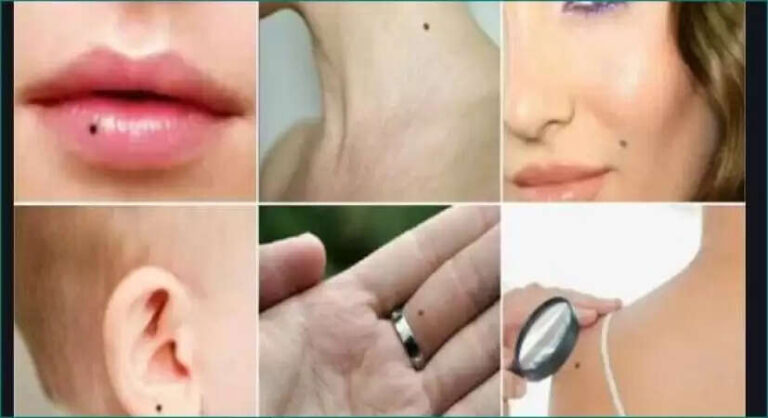 Moles on Different parts of the Body & their meaning as per Astrology Explained!