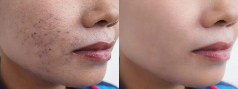 Top 6 Creams For Chicken Pox Scars