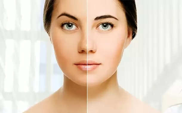Learn About Skin Whitening Treatment Without Any Surgery