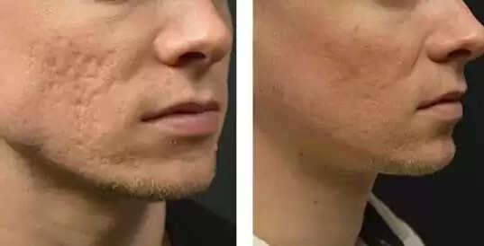 Known About The Best Face Scar Treatment in Mumbai (Acne Scar)