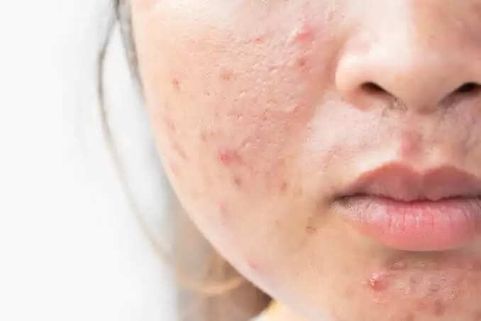 Best Home Remedies Get Rid Of Acne Scars