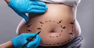 Know About Liposuction, Non Invasive & Non Surgical Laser Lipo