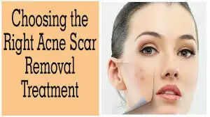 What Are The Risks and Side Effects of Face Scar Treatments
