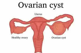 Ovary Meaning Explained in Hindi: ओवरी क्या है? लक्षण और उपचार