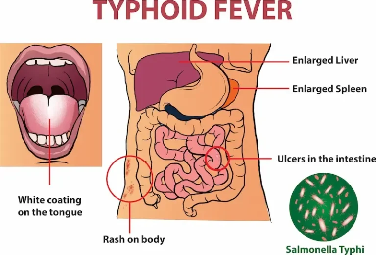 Typhoid Fever